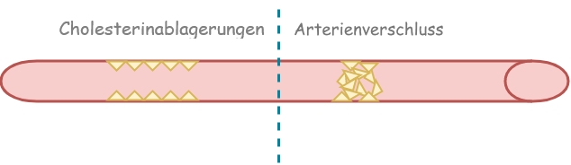 Cholesterinablagerungen Arterienverschluss